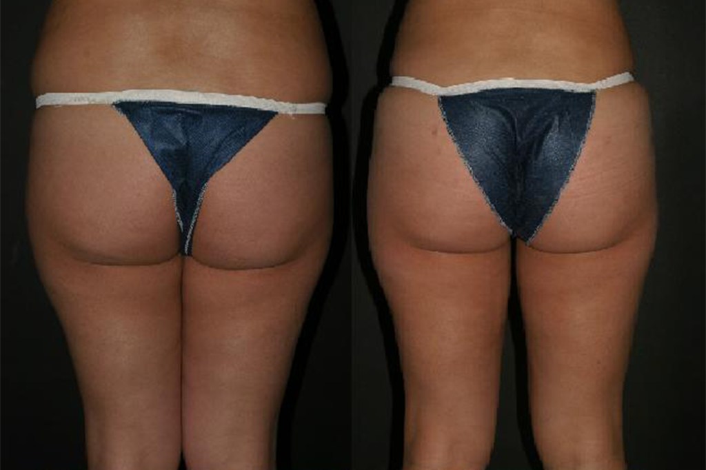 Before and after comparison of a woman's buttock augmentation and lipoinjection procedure